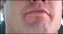 Marina Del Rey Bee Removal Guy Anthony right after being stung on the lip.