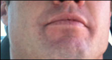 Beverly Hills Bee Removal Guy Anthony right after being stung on the lip.