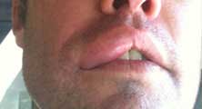 Venice Bee Removal Guy Anthony picture of swelling after being stung 
    on the lip.